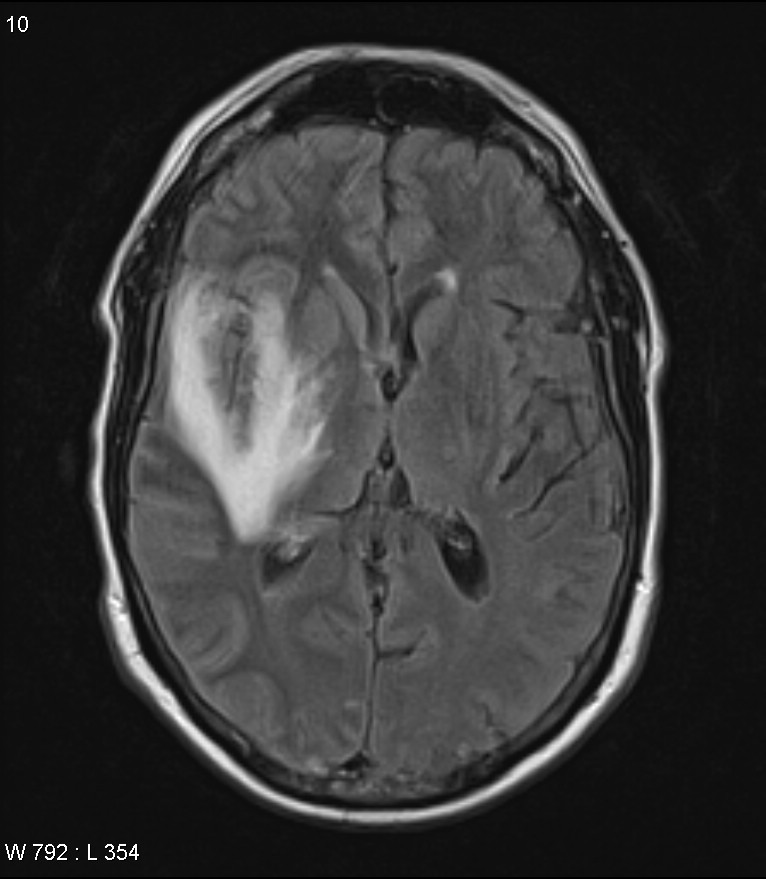 Encephalitis - Neurology - Medbullets Step 2/3